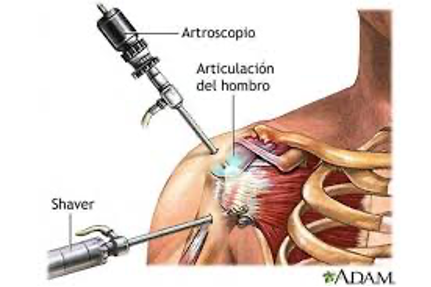 Dolor hombro
