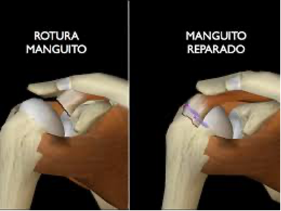 Dolor hombro