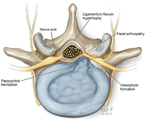 Dolor lumbar
